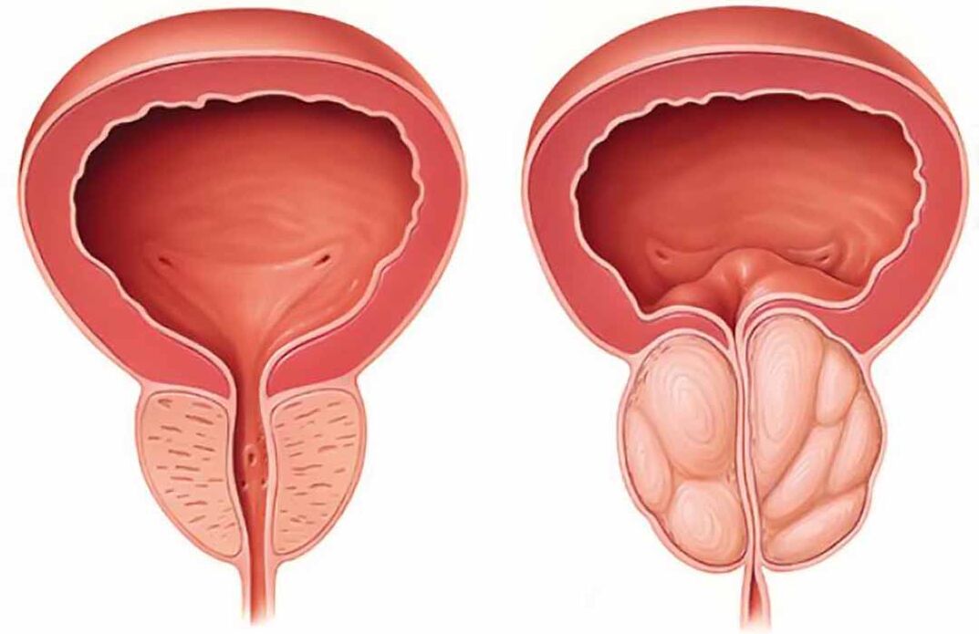 Нормальная простата и воспаление предстательной железы (хронический простатит)