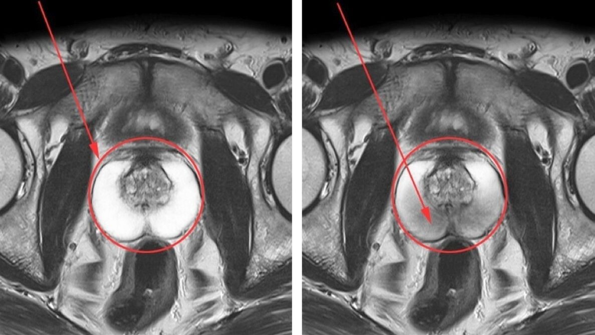 УЗИ при хроническом простатите – здоровая (слева) и воспаленная (справа) простата