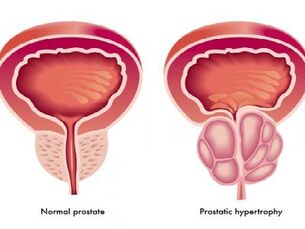 Нормальная и воспаленная простата
